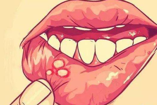 口腔溃疡不能吃辣椒